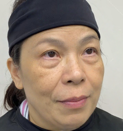 去眼袋手术