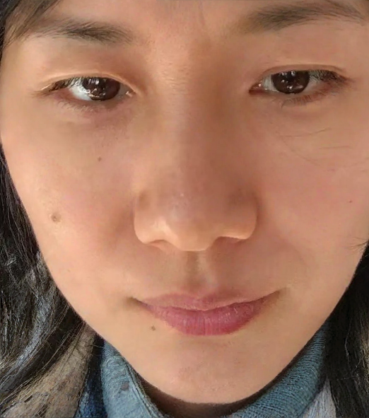 去眼袋手术