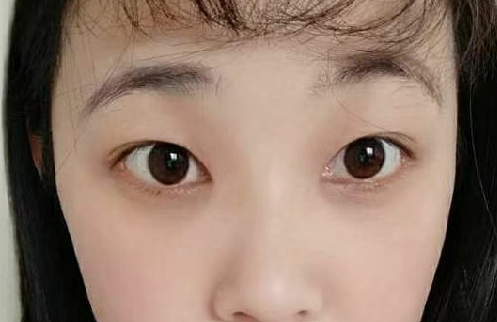 去眼袋手术