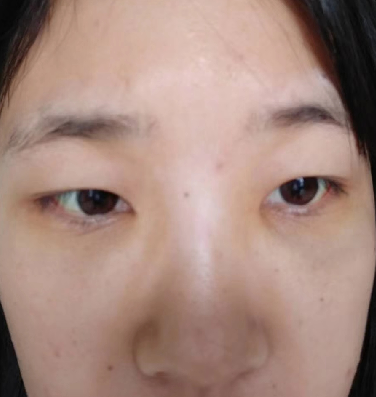去眼袋手术