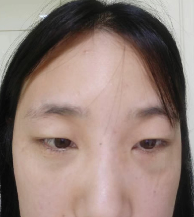 去眼袋手术