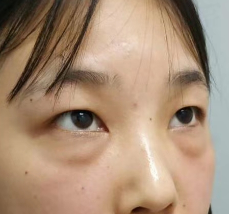 去眼袋手术