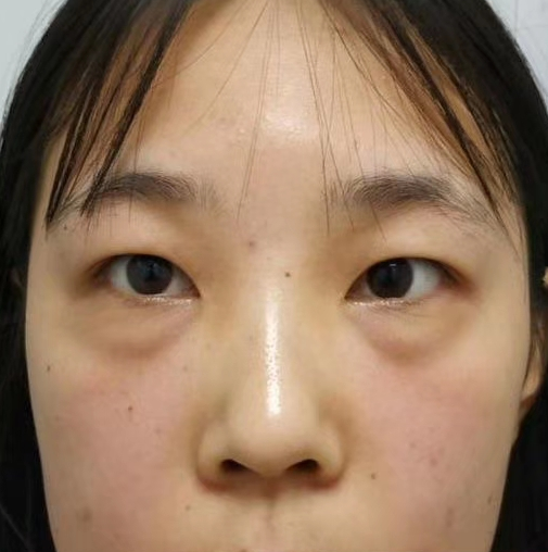 去眼袋手术