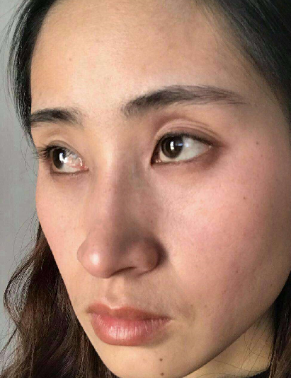 去眼袋手术