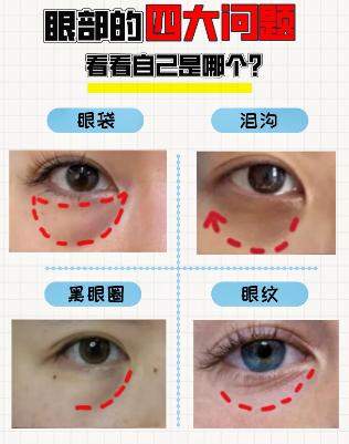 去眼袋手术