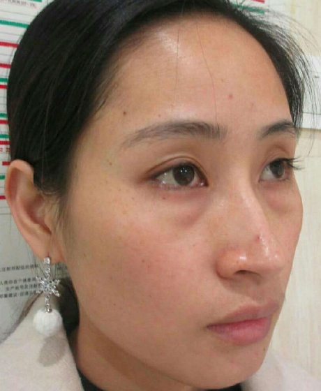 去眼袋手术