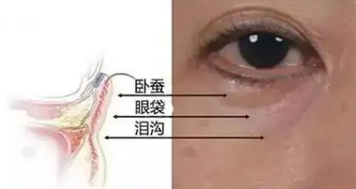 去眼袋手术