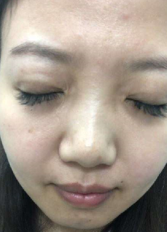 去眼袋手术