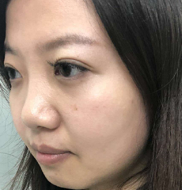 去眼袋手术