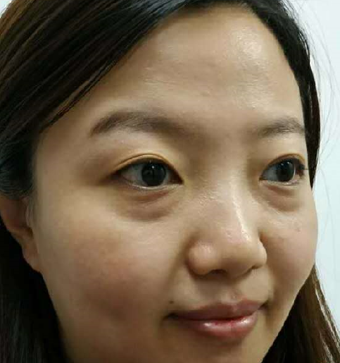 去眼袋手术
