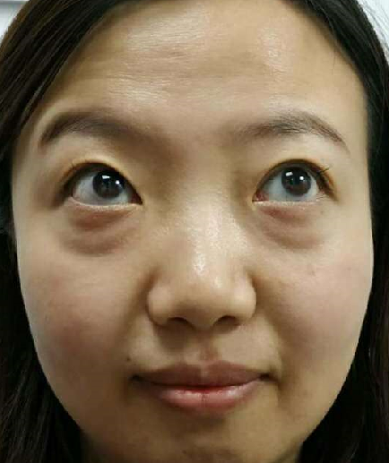 去眼袋手术