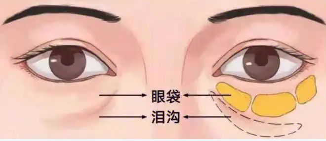 眼袋