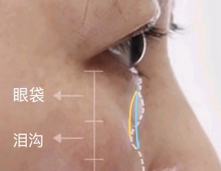 眼袋