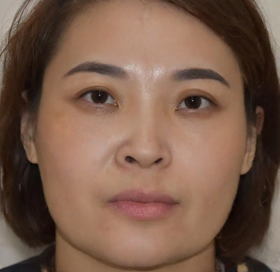 去眼袋手术