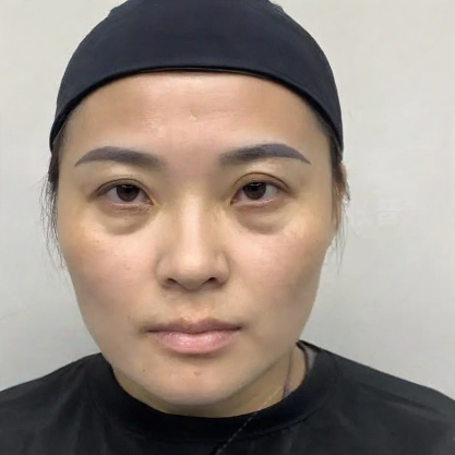 去眼袋手术