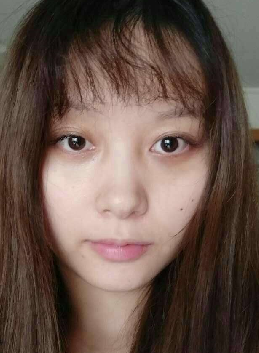 去眼袋手术