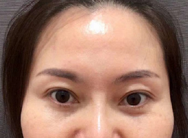 去眼袋手术