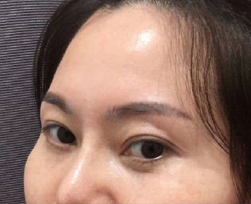 去眼袋手术