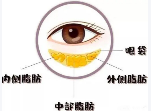 去眼袋手术
