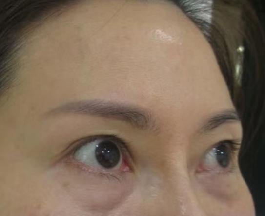 去眼袋手术