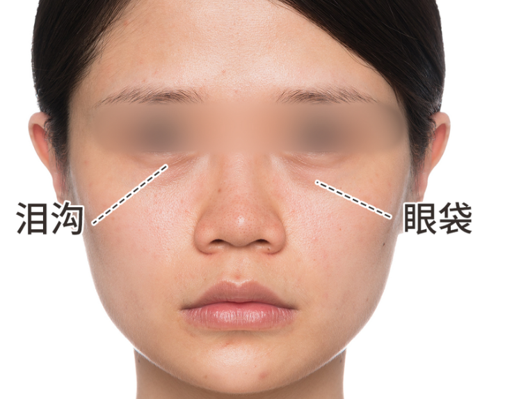 眼袋