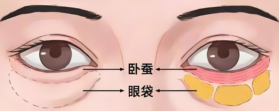 眼袋