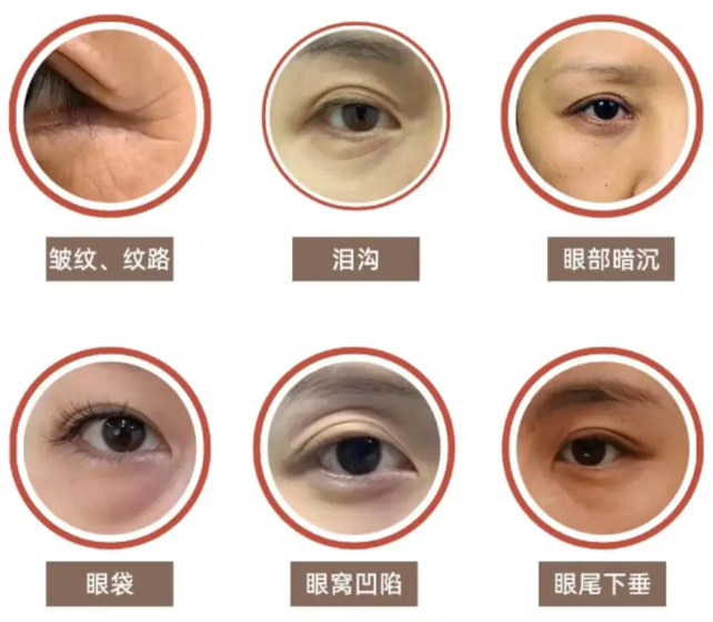 眼袋