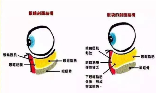 去眼袋手术
