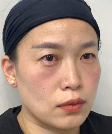 去眼袋手术