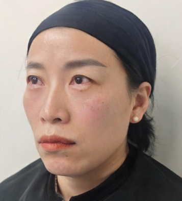 去眼袋手术