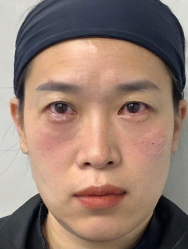 去眼袋手术