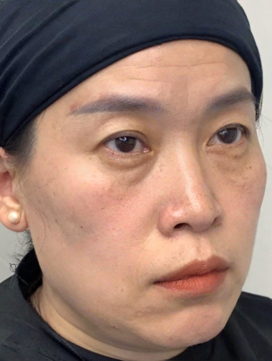 去眼袋手术