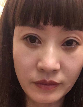 去眼袋手术