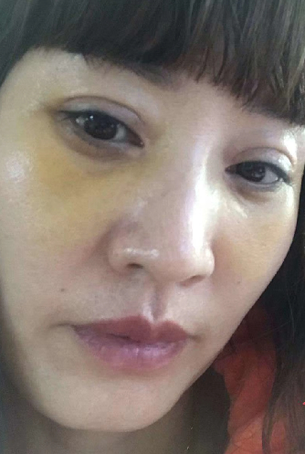 去眼袋手术