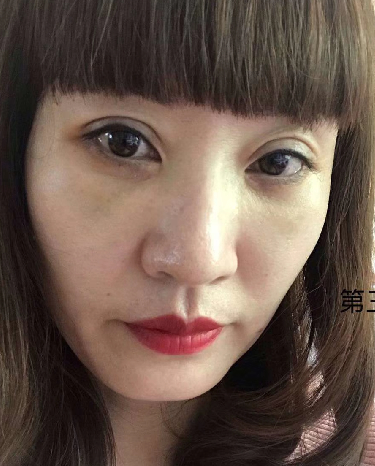 去眼袋手术