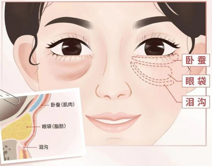 去眼袋手术
