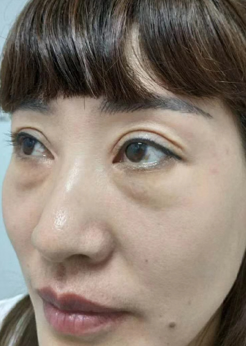 去眼袋手术
