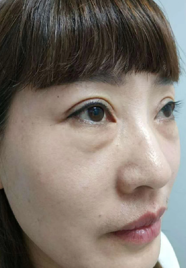 去眼袋手术