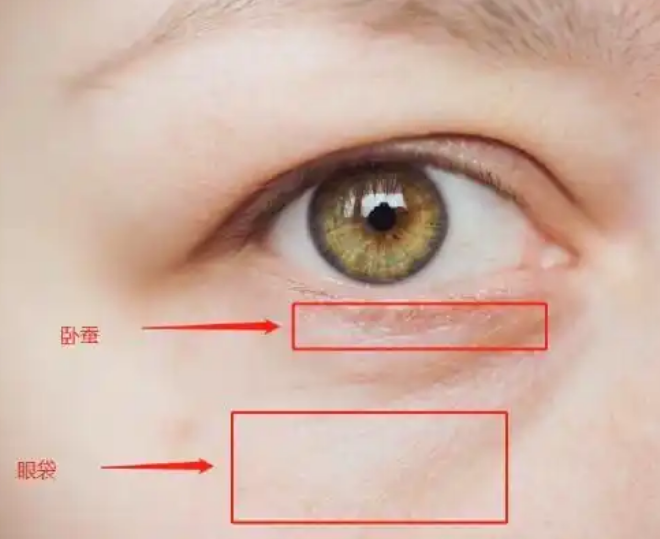 去眼袋手术