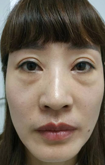 去眼袋手术