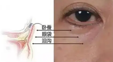 去眼袋手术
