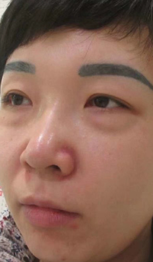 去眼袋手术