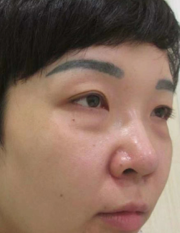 去眼袋手术
