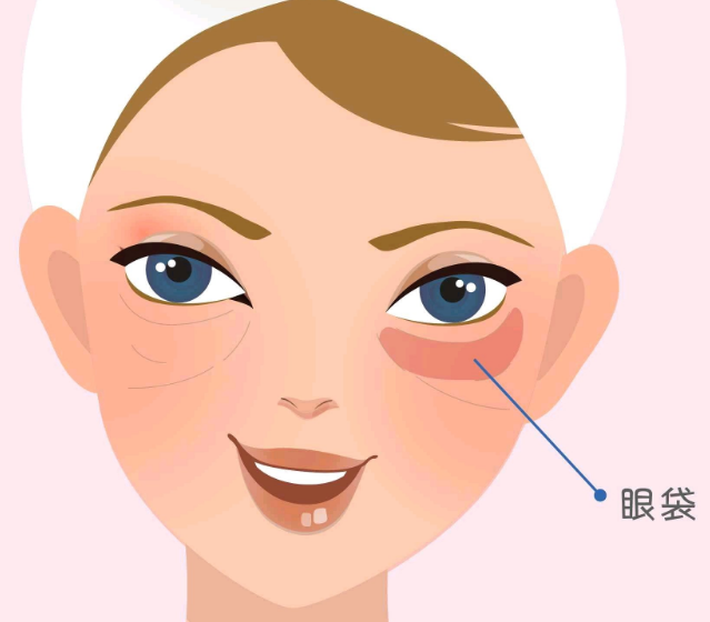 去眼袋手术