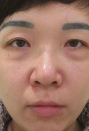 去眼袋手术