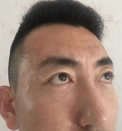 去眼袋手术
