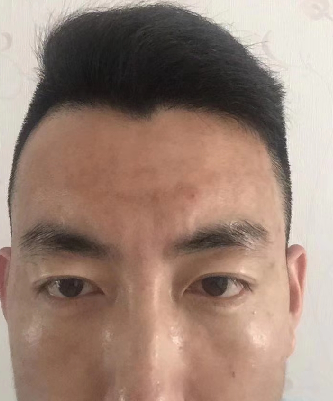 去眼袋手术