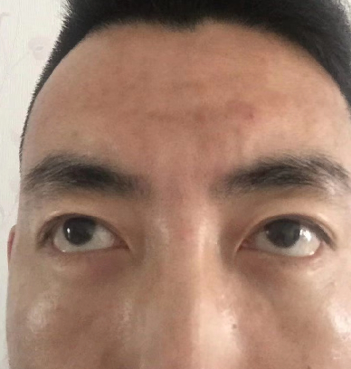 去眼袋手术