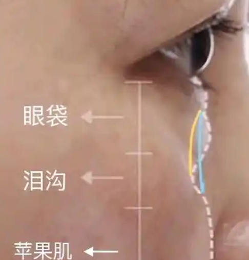 去眼袋手术