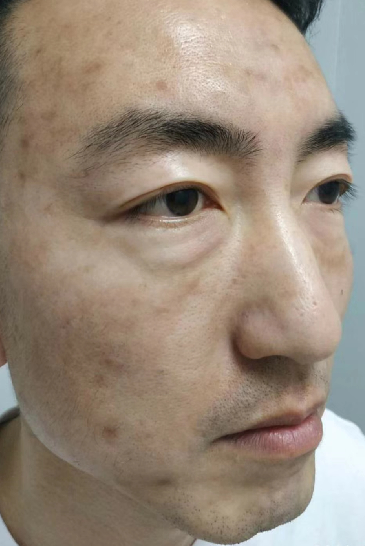 去眼袋手术